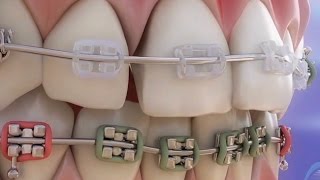 Braces – Elements of the orthodontics and its role ©