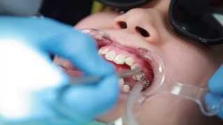 Braces: Putting Braces On Bonding Procedure – Aura Orthodontics