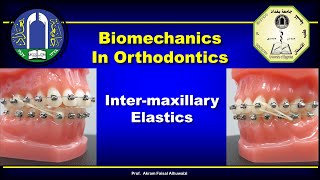 Intermaxillary Elastics in Orthodontics