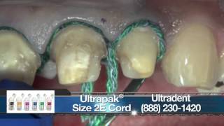 Replacing Crowns on Teeth #7-10 With BruxZir® Anterior