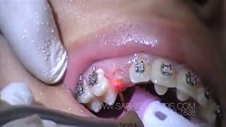 Laser Canine Exposure in Orthodontics