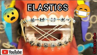 Elastics / Rubber Bands During Braces Or Invisalign. Orthodontist Explains All You Need To Know!