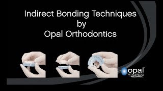 Indirect Bonding by Opal Orthodontics