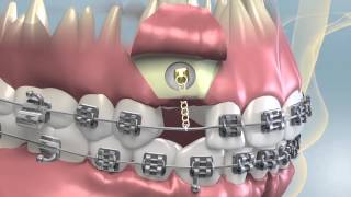 Impacted Tooth Exposure & Uncovering For Orthodontics