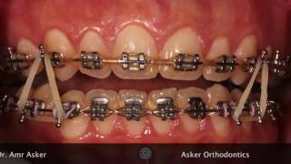 deep bite in orthodontics, orthodontic courses and education by asker orthodontics Dr. Amr Asker