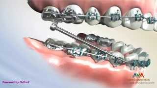 Different Types of Forsus – Orthodontic Appliance