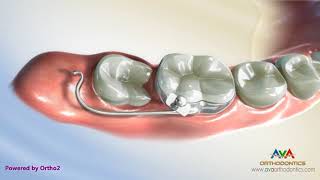 Orthodontic Treatment for Molar Uprighting – Halterman Appliance