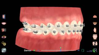 Orthodontic Treatment Simulation with Damon Brackets