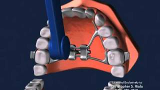 Seattle Orthodontist Dr. Christopher Riolo: Banded Expander, RPE