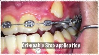 crimpable stop application in orthodontics