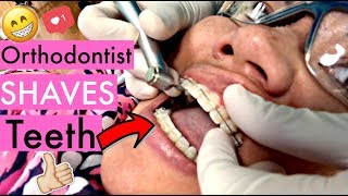 BRACES VLOG: My Orthodontist SHAVED My Teeth! "Incisal Edge Contouring" for a more perfect smile