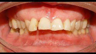 Orthodontic Treatment of Deep Overbite & Increased Overjet – Mousa 37 years