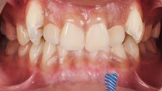 Braces (Orthodontic Treatment) Journey Before & After Transformation Third video Results