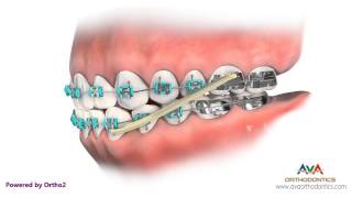 Orthodontics Treatment for Underbite or Crossbite – Rubber Bands