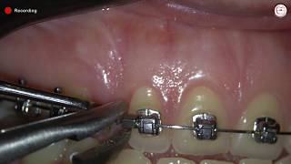 Activation of open coil spring in orthodontics by using crimpable stop Dr. Amr Asker