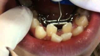 Lower Teeth Expander: Getting Braces On: Nirenblatt Orthodontics: