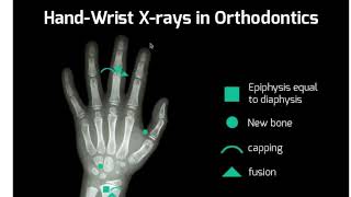 How to Read a Hand/Wrist Xray for Orthodontics- StraightSmile Solutions Method