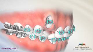 Orthodontic Treatment for Impacted Canine – Laser Exposure