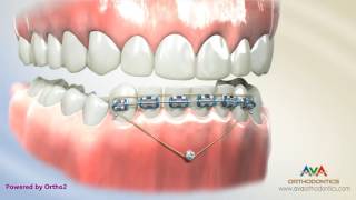 Orthodontic Treatment for Deepbite – Temporary Anchorage Device or TAD