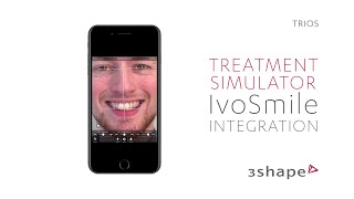 TRIOS Treatment Simulator & IvoSmile Orthodontics Integration Workflow