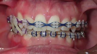 Orthodontic Transformation from Start to Finish