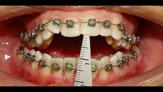 Non Surgical orthodontic treatment of Skeletal Anterior Open Bite