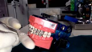 Demo of lace back – Insight Orthodontics