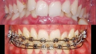 Amazing Deep Bite Correction: Orthodontist!