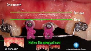 Orthodontic extrusion for remaining roots to get ferrule effect for bridge ,, ortho course