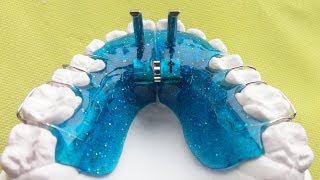 Vorschubdoppelplatte, Angle 2, Sander 2, Doppel-Vorschubplatte, Double Plate, KFO, Orthodontics