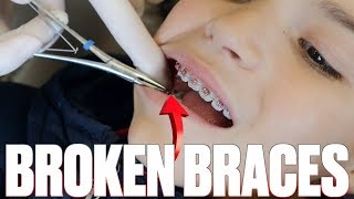 UNEXPECTED VISIT TO THE ORTHODONTIST | FIRST TIME BRACES WIRE BROKE OFF