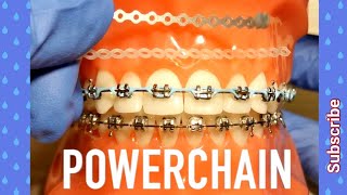 Power Chain on Braces. How Painful Is It?! Orthodontist Explains All You Need To Know!