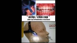 OCLIP CHIN CUP TREATMENT ORTHODONTICS