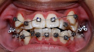 Niềng răng lòi sỉ p.2 | orthodontic before after | Braces