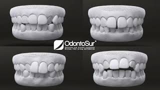 ortodoncia invisible, Orthodontics with out braces. Aligners Dr. César Moncada Díez,