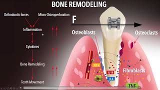 Dental Treatment: Accelerated Orthodontics Jun 28, 2016