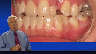 Rondeau Seminars Orthodontics Level II Sample Case – Mai Part 1