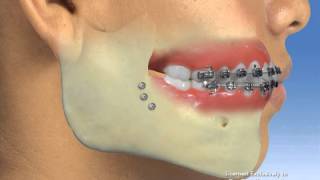 Orthodontics – Surgery