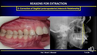 Extraction in Orthodontics