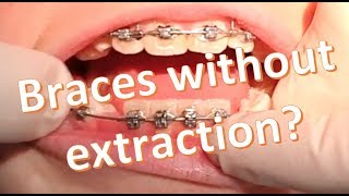 Non-extraction Orthodontics: 2×4 D-gainer Mechanics