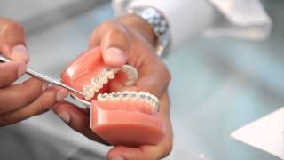 Braces: Broken Bracket, Poking Wire, Braces Pain – Aura Orthodontics