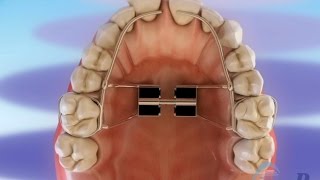 Orthodontic devices – Palatal expander and headgear ©