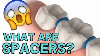 ORTHODONTIC SPACERS: WHAT ARE THEY AND WHY DO YOU NEED THEM?