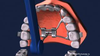 Advanced Orthodontics – Expanders