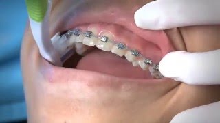 Taking Care of Your Braces – Spillers Orthodontics, Orthodontist, Macon & Warner Robins GA