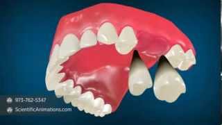 Nance Appliance – Orthodontist