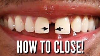 Orthodontic closing springs (Diastema) lesson