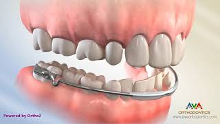 Orthodontic Space Management – Lip Bumper Appliance