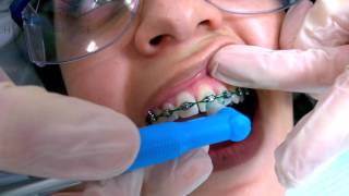 Tips on Using the Occlusal Brush for Orthodontics