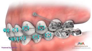 Temporary Anchorage Device or TAD – Orthodontic Appliance